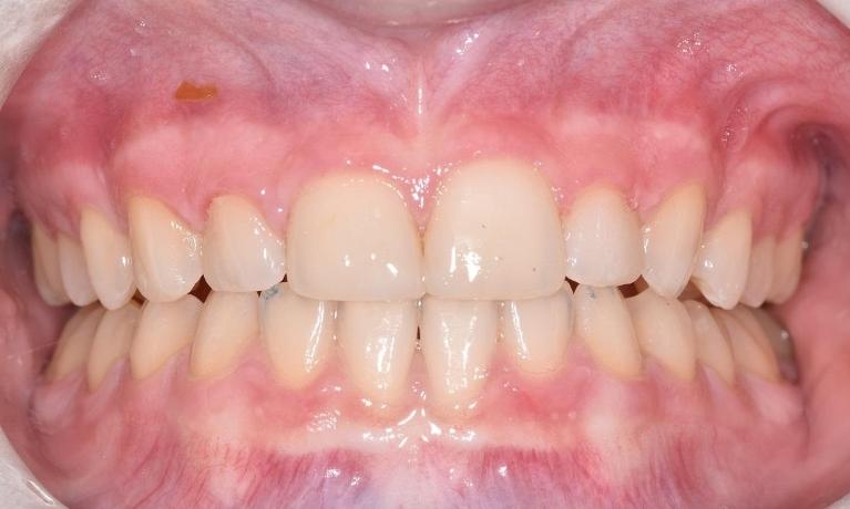 Anterior-Bonding-After-Image