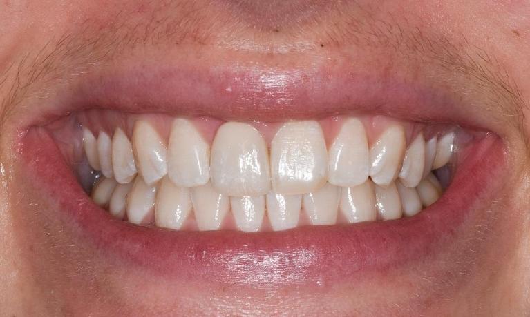 Anterior-Ceramic-Crowns-After-Image