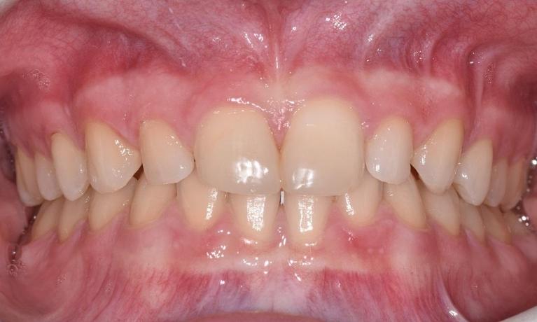 Anterior-Bonding-Before-Image