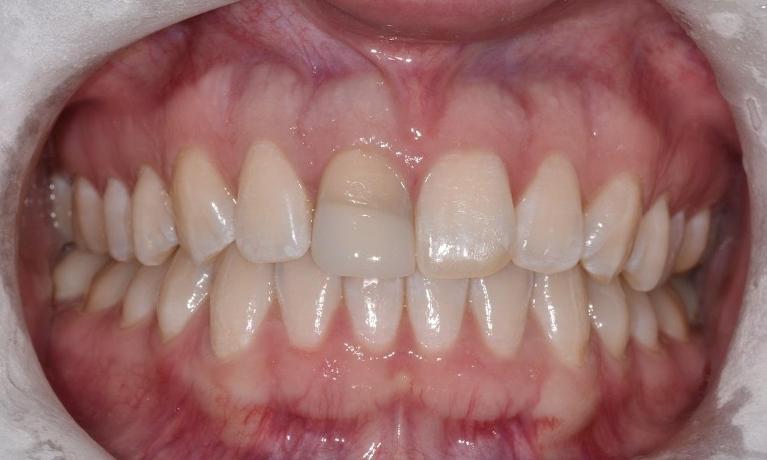 Anterior-Ceramic-Crowns-Before-Image