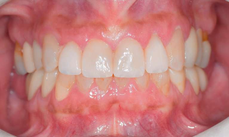 Cosmetic-Crowns-Veneers-After-Image