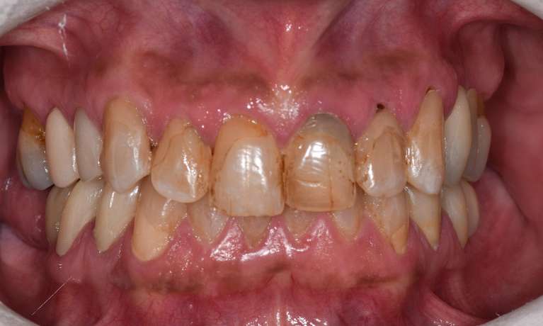 Cosmetic-Crowns-Veneers-Before-Image